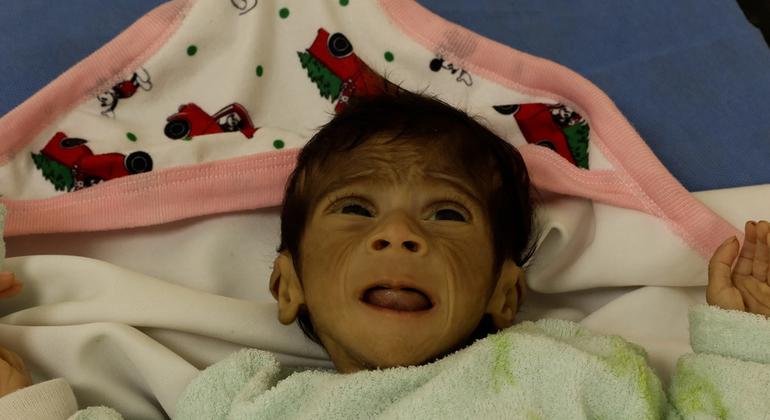 Un enfant souffrant de malnutrition sévère est pris en charge à l'hôpital Abdel Aziz Al-Rantisi, dans la bande de Gaza.